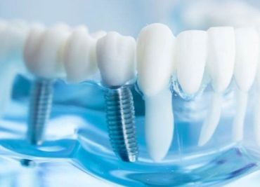 Implantes dentales