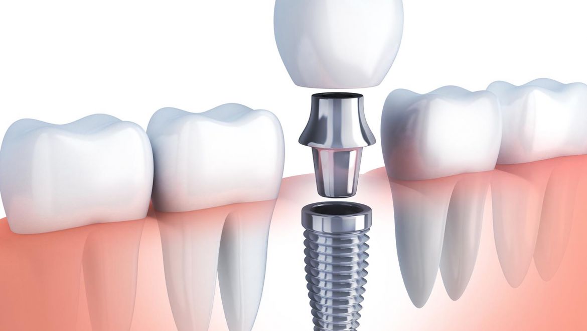 ¿Por qué se usa titanio en los implantes dentales?