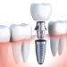 ¿Por qué se usa titanio en los implantes dentales?